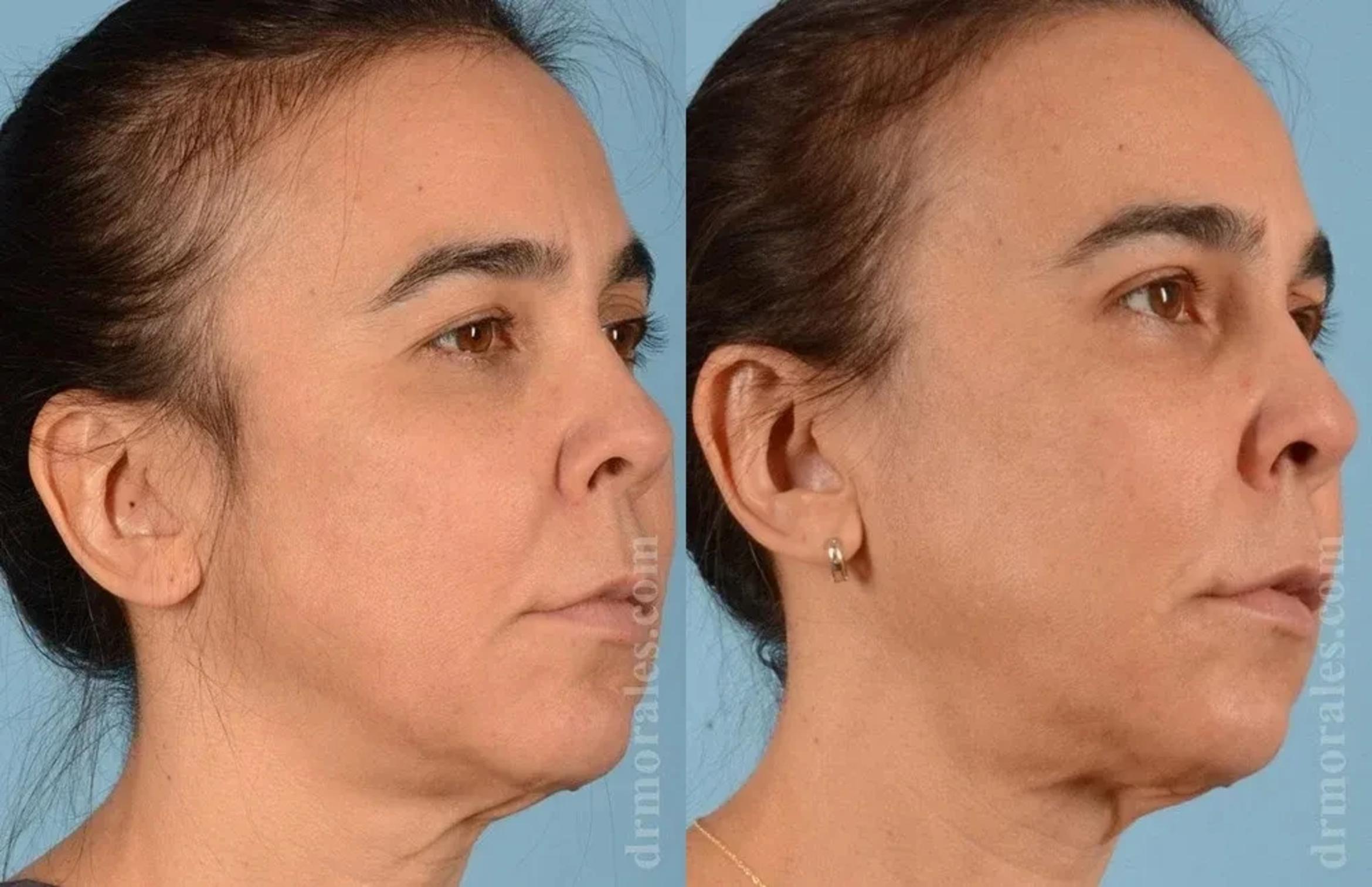 Before & After Eyelid Surgery Case 129 View 1 View in Houston, TX