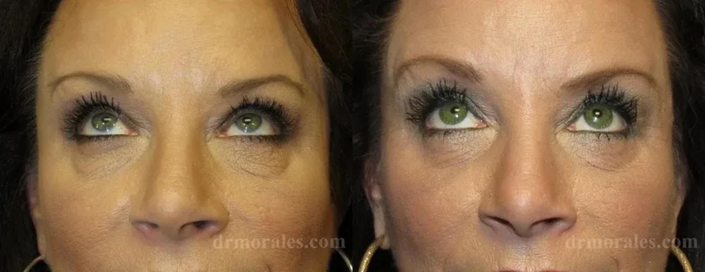 Before & After Eyelid Surgery Case 130 View 1 View in Houston, TX