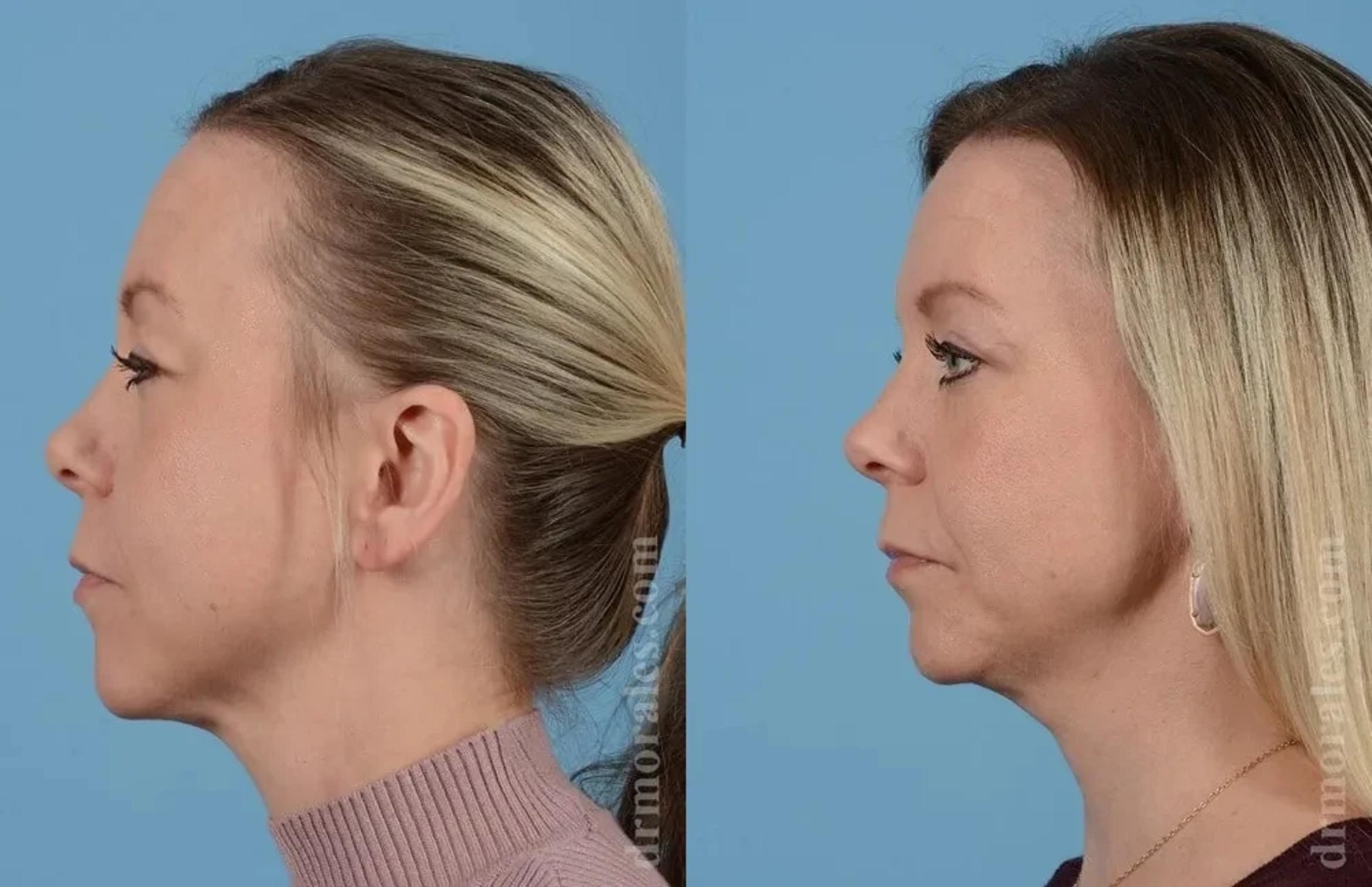 Before & After Eyelid Surgery Case 131 View 1 View in Houston, TX