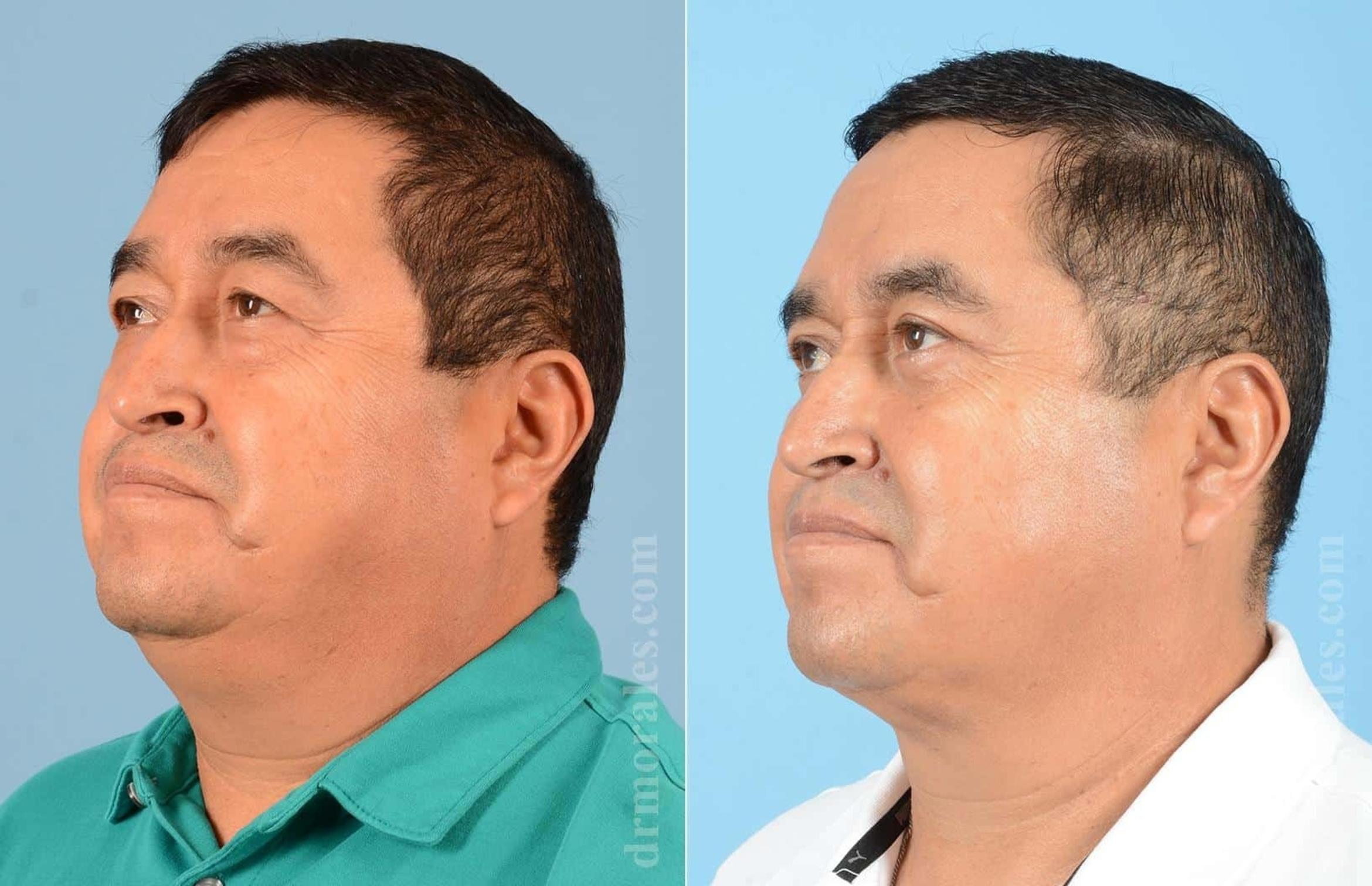 Before & After Eyelid Surgery Case 18 View 1 View in Houston, TX