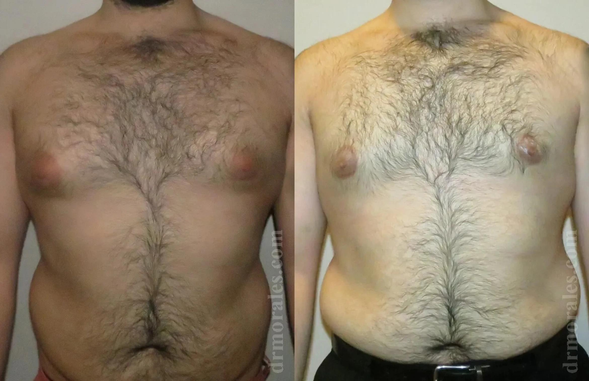 Before & After Gynecomastia Case 141 View 1 View in Houston, TX
