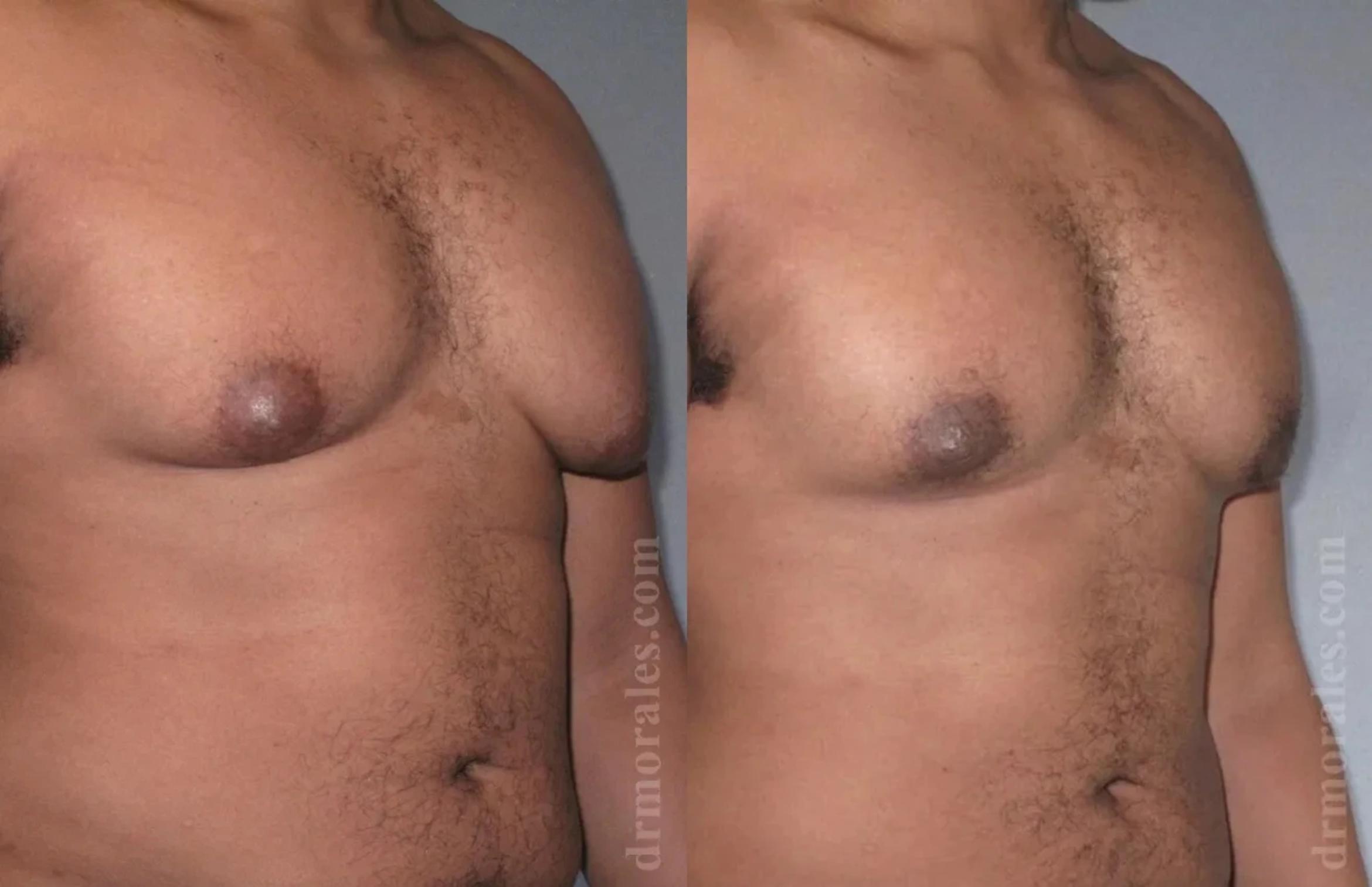 Before & After Gynecomastia Case 145 View 1 View in Houston, TX