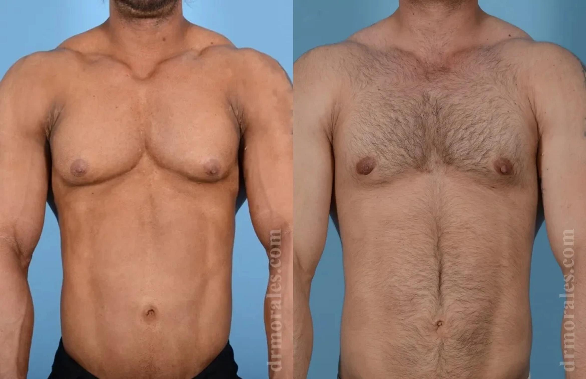 Before & After Gynecomastia Case 154 View 1 View in Houston, TX