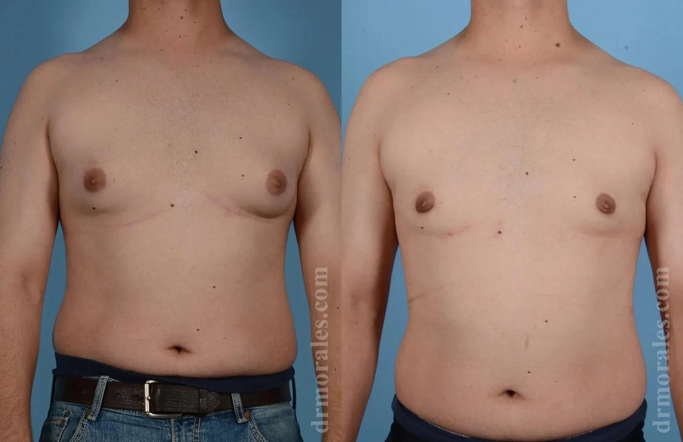 Before & After Gynecomastia Case 161 View 1 View in Houston, TX