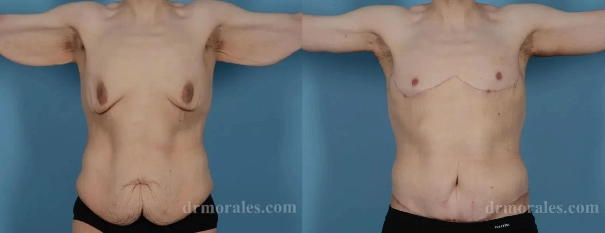Before & After Arm Lift Case 195 View 1 View in Houston, TX