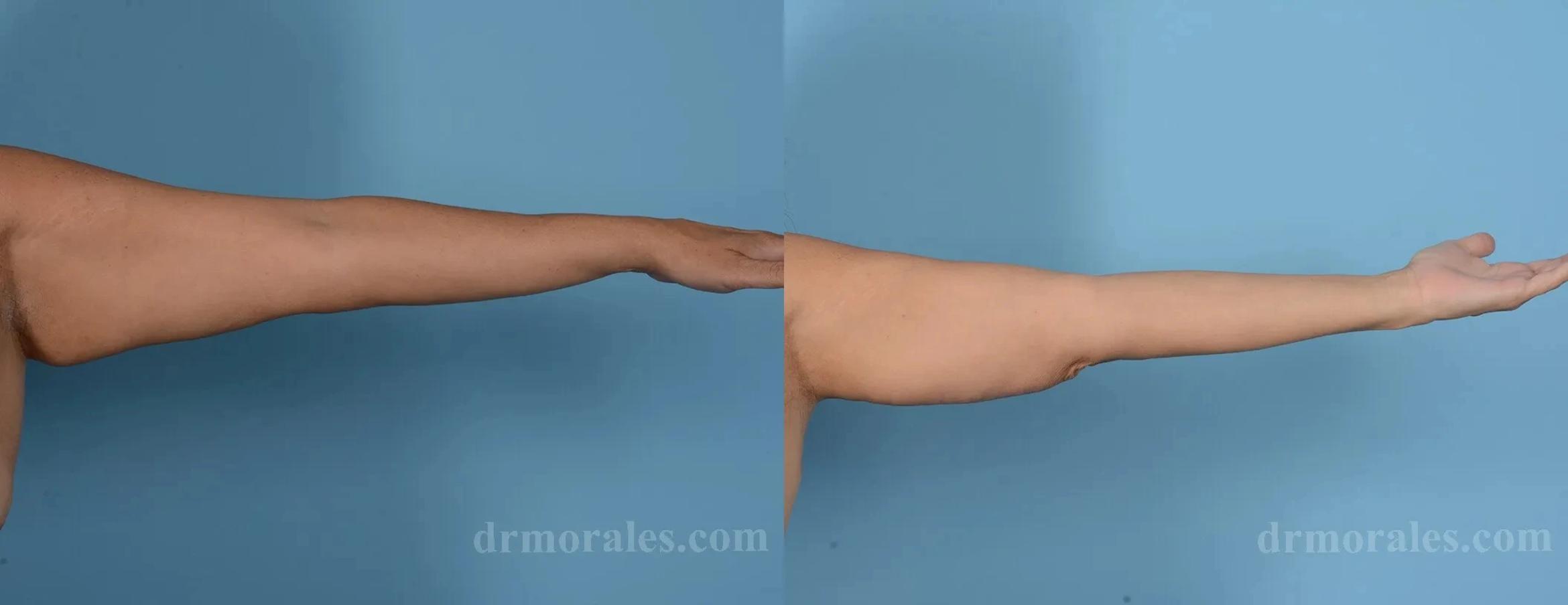 Before & After Arm Lift Case 198 View 1 View in Houston, TX
