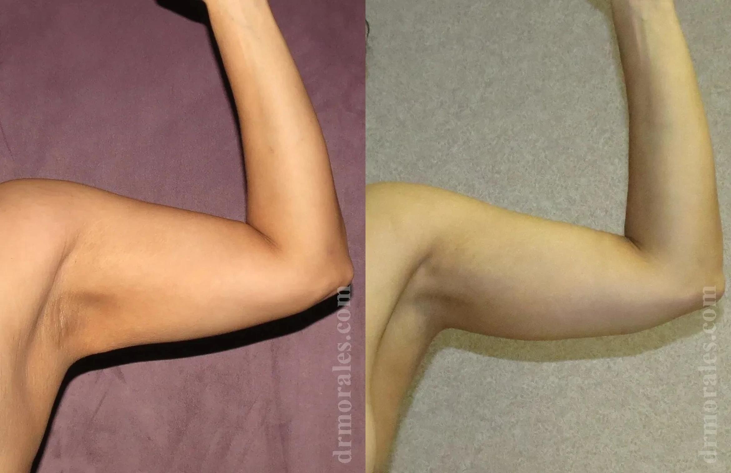 Before & After Arm Lift Case 199 View 1 View in Houston, TX
