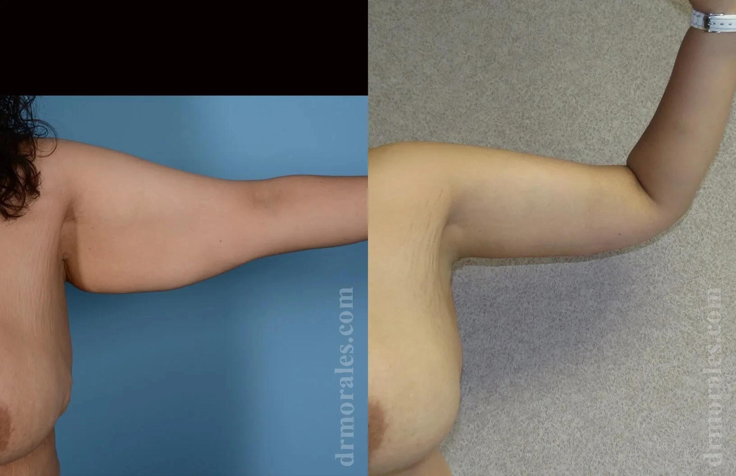 Before & After Arm Lift Case 200 View 1 View in Houston, TX