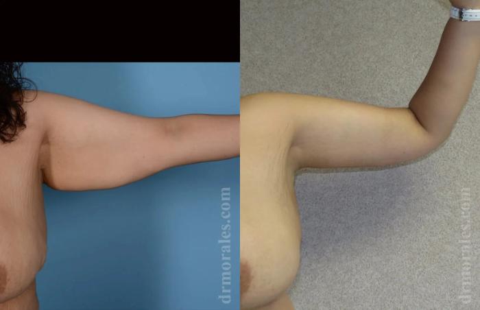 Before & After Arm Lift Case 200 View 1 View in Houston, TX