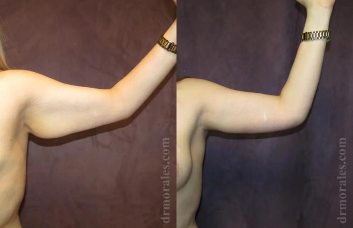 Before & After Arm Lift Case 201 View 1 View in Houston, TX