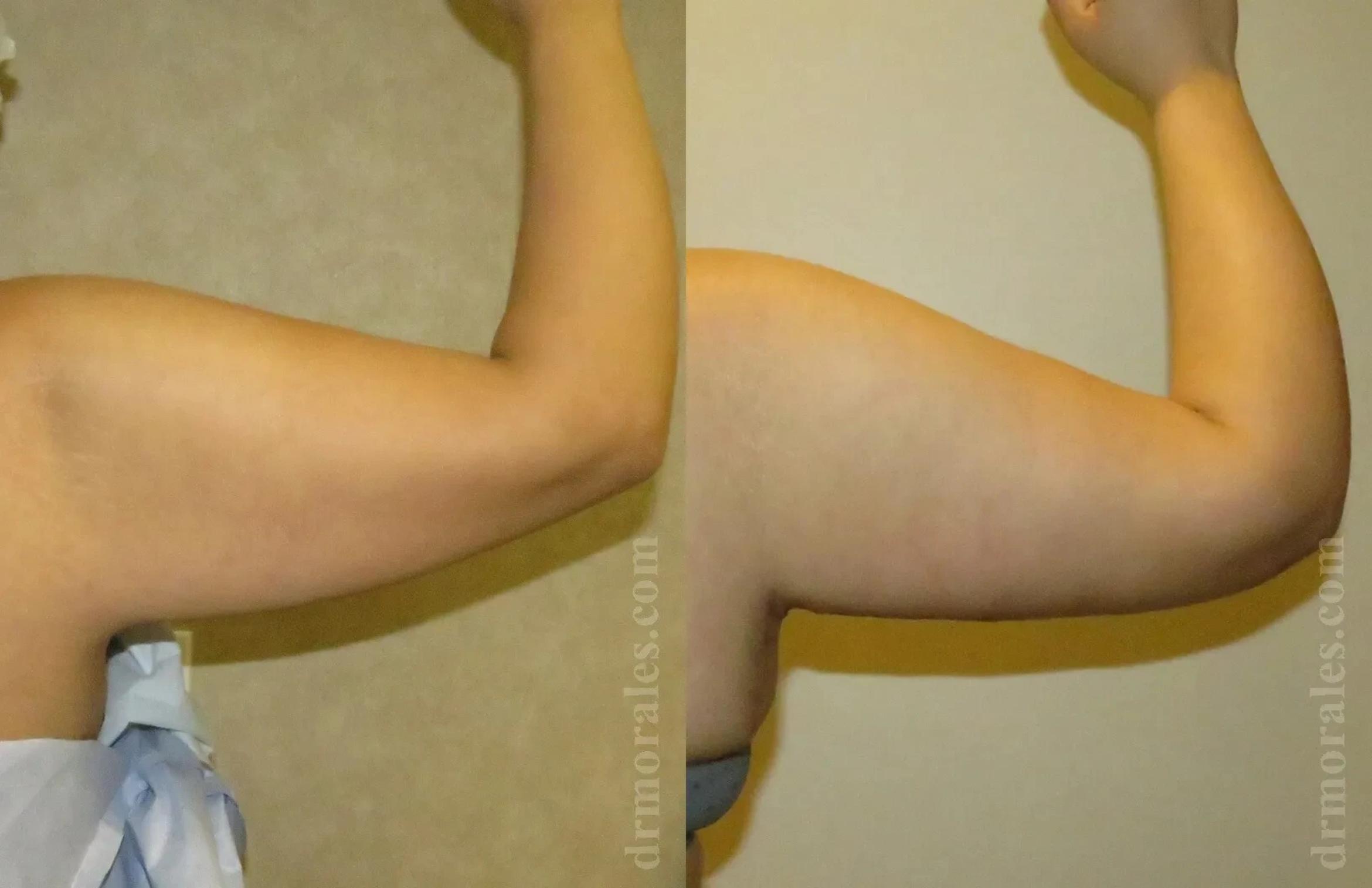 Before & After Arm Lift Case 202 View 1 View in Houston, TX