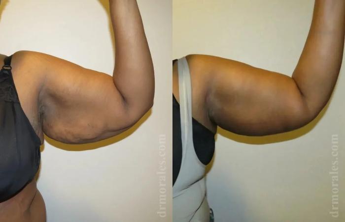 Before & After Arm Lift Case 203 View 1 View in Houston, TX