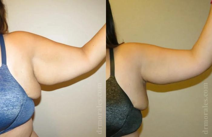 Before & After Arm Lift Case 204 View 1 View in Houston, TX
