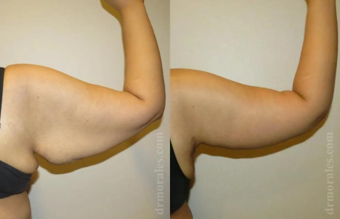 Before & After Arm Lift Case 205 View 1 View in Houston, TX