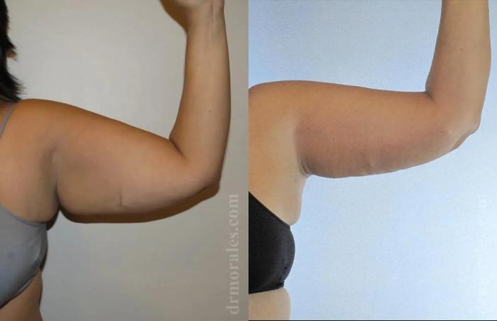 Before & After Arm Lift Case 206 View 1 View in Houston, TX