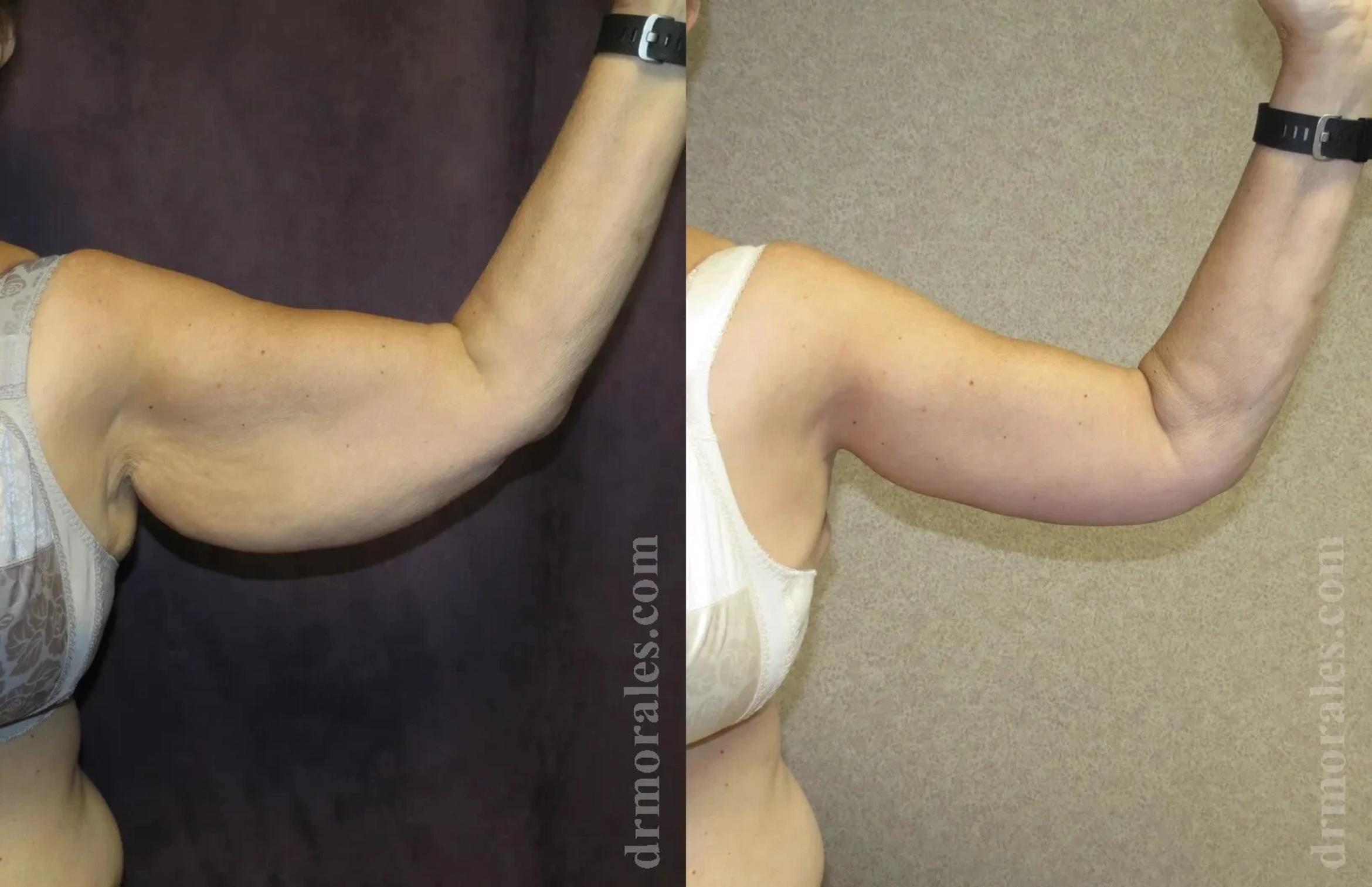 Before & After Arm Lift Case 207 View 1 View in Houston, TX