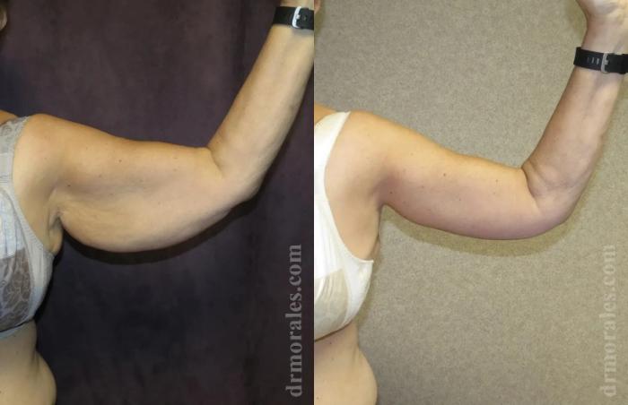 Before & After Arm Lift Case 207 View 1 View in Houston, TX