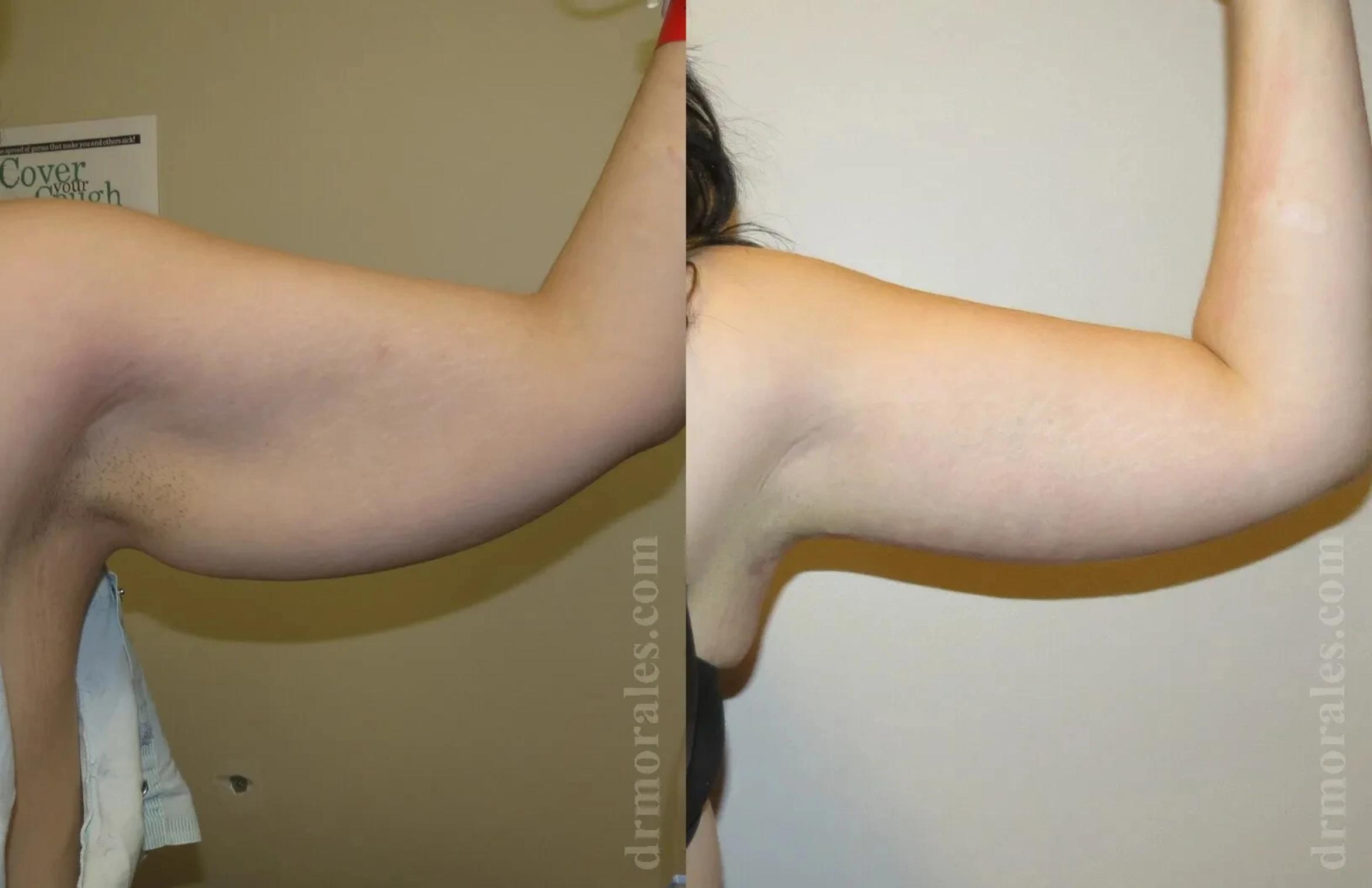 Before & After Arm Lift Case 208 View 1 View in Houston, TX
