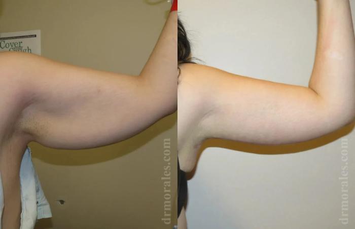 Before & After Arm Lift Case 208 View 1 View in Houston, TX