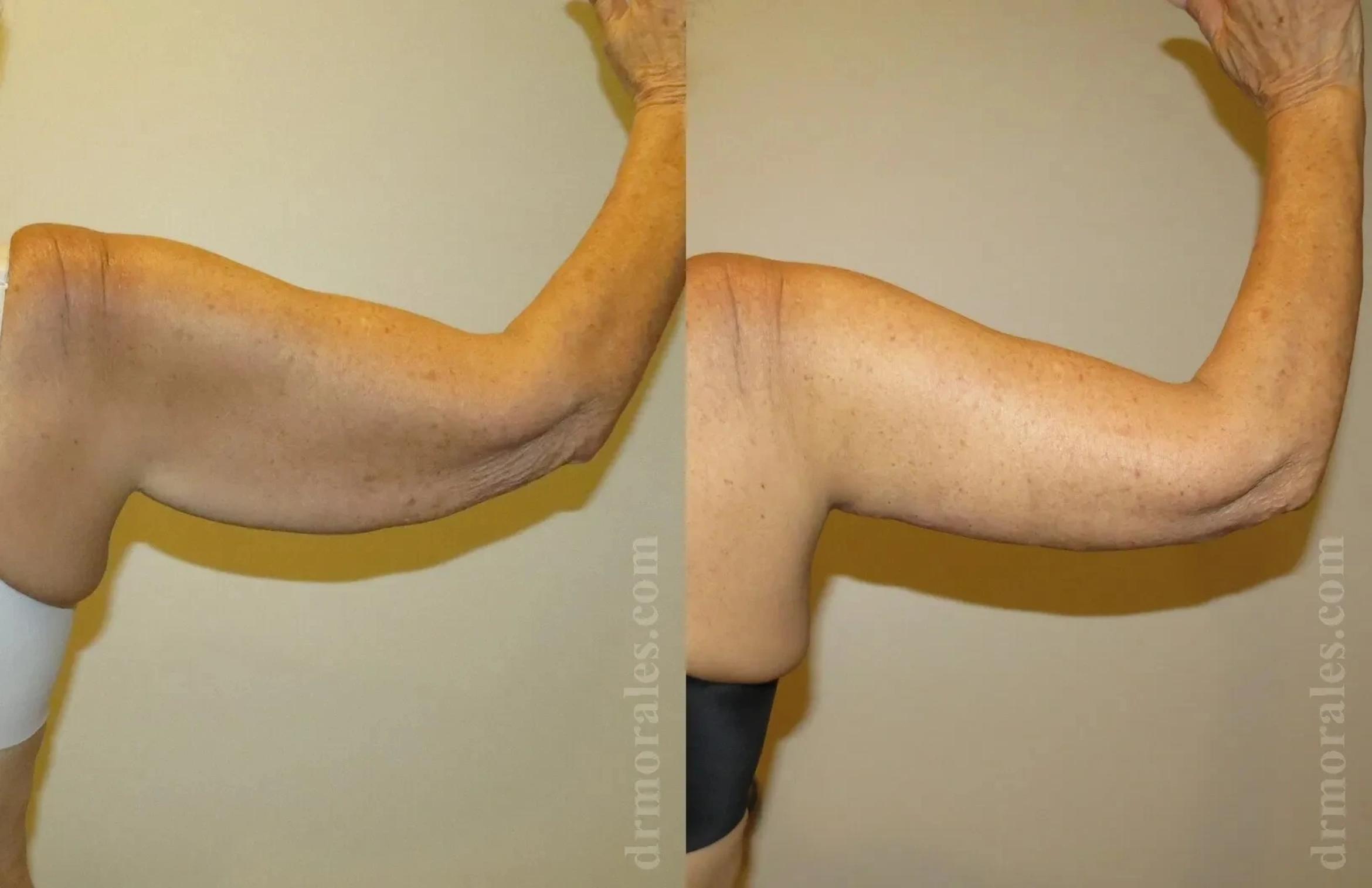 Before & After Arm Lift Case 209 View 1 View in Houston, TX
