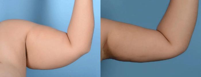Before & After Arm Lift Case 211 View 1 View in Houston, TX