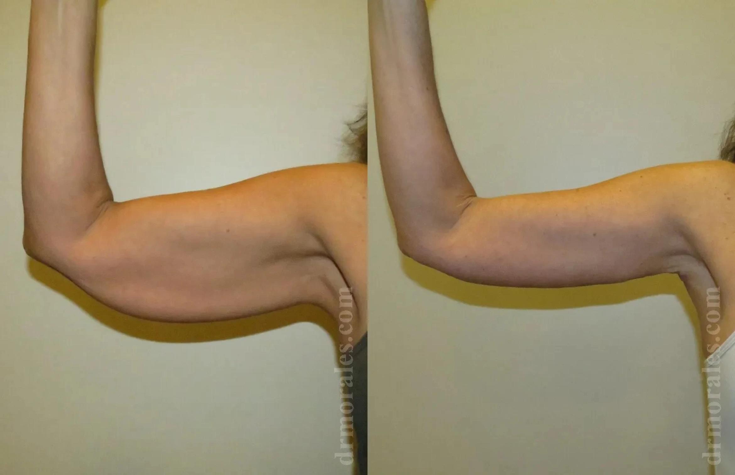Before & After Arm Lift Case 212 View 1 View in Houston, TX