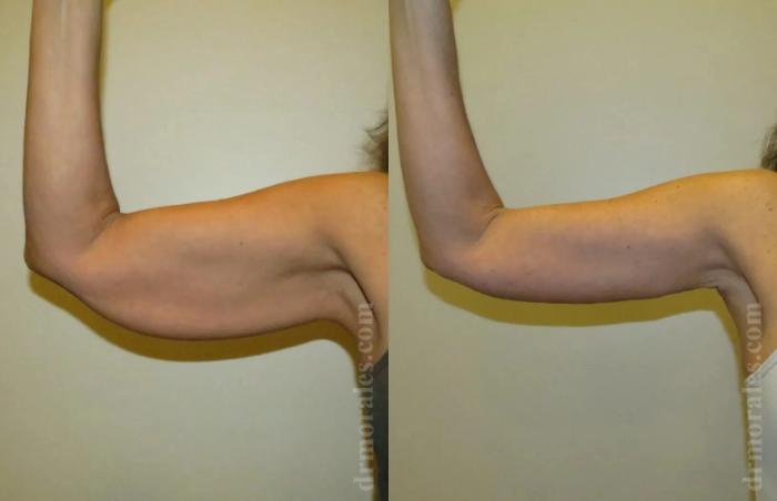 Before & After Arm Lift Case 212 View 1 View in Houston, TX