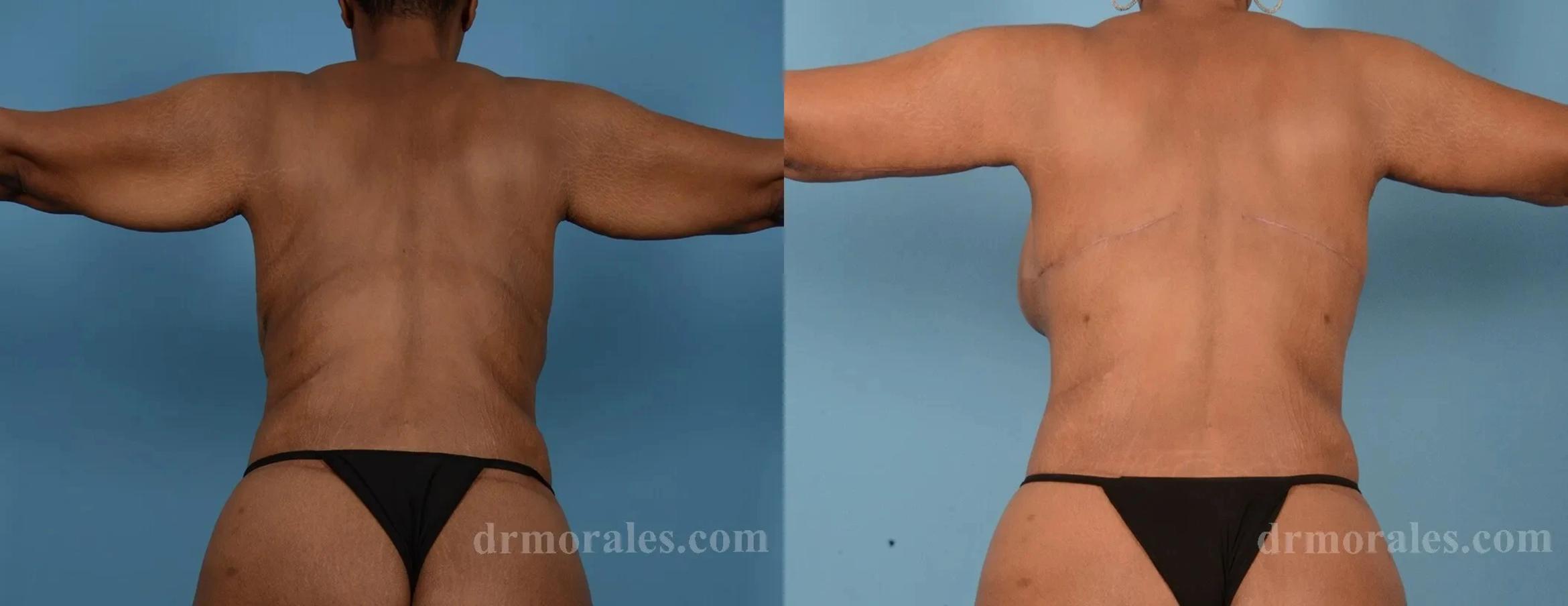 Before & After Arm Lift Case 213 View 1 View in Houston, TX