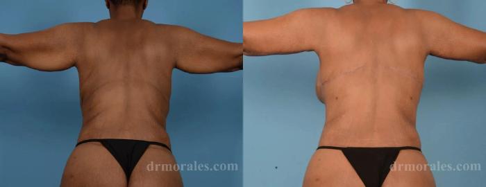 Before & After Arm Lift Case 213 View 1 View in Houston, TX
