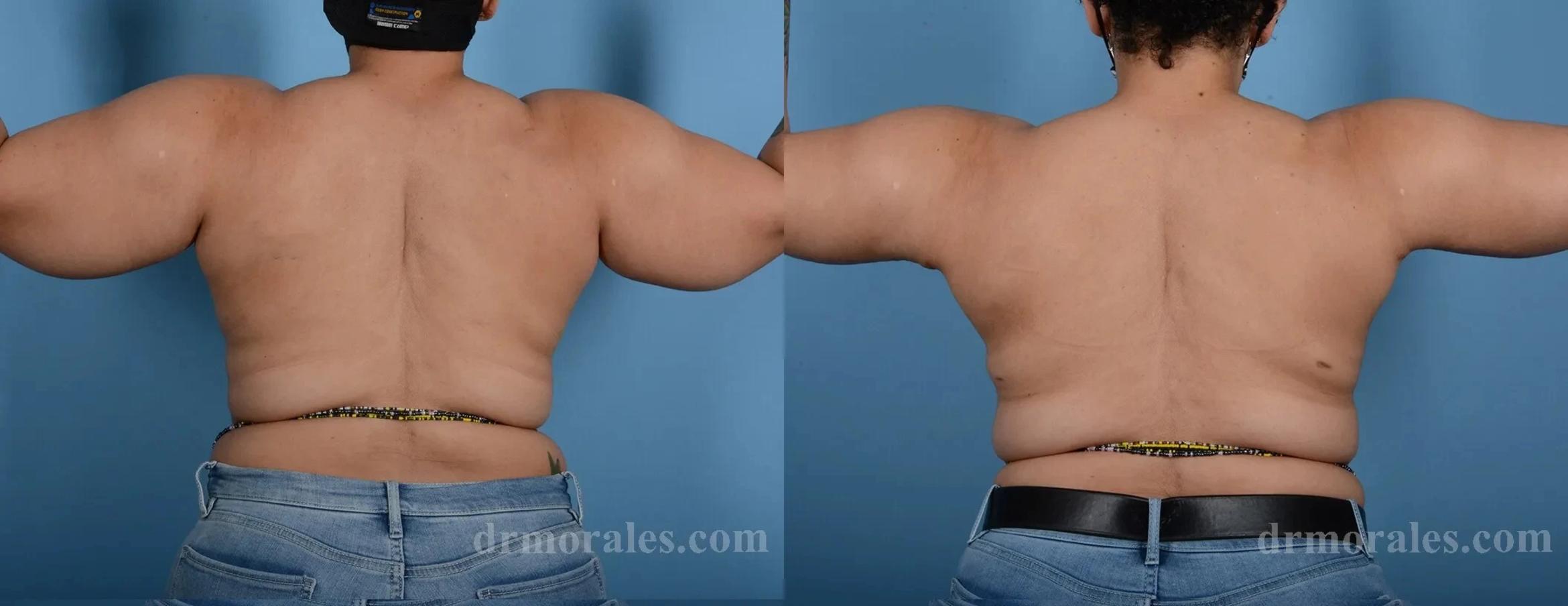 Before & After Arm Lift Case 216 View 1 View in Houston, TX