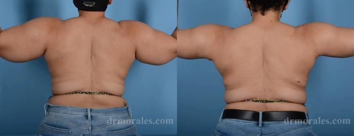 Before & After Arm Lift Case 216 View 1 View in Houston, TX