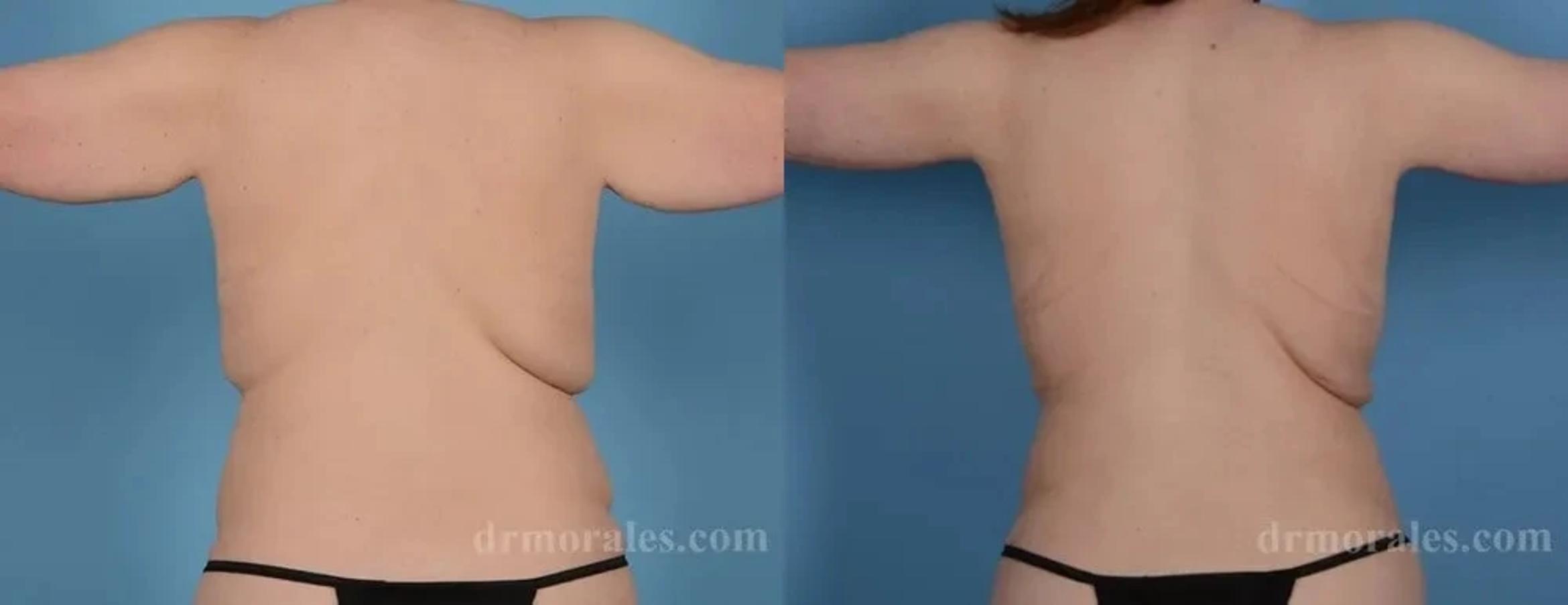 Before & After Arm Lift Case 219 View 1 View in Houston, TX