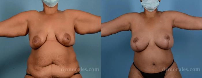 Before & After Arm Lift Case 220 View 1 View in Houston, TX