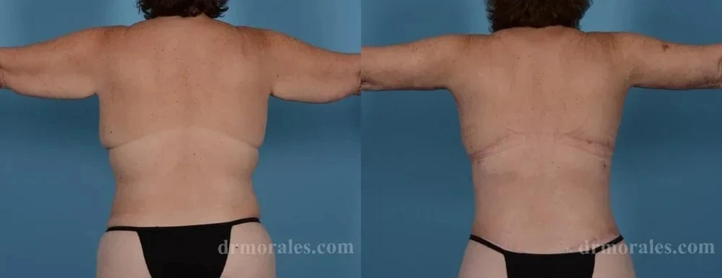 Before & After Arm Lift Case 221 View 1 View in Houston, TX