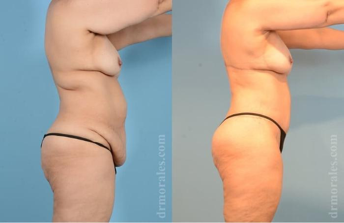 Before & After Arm Lift Case 24 View 1 View in Houston, TX