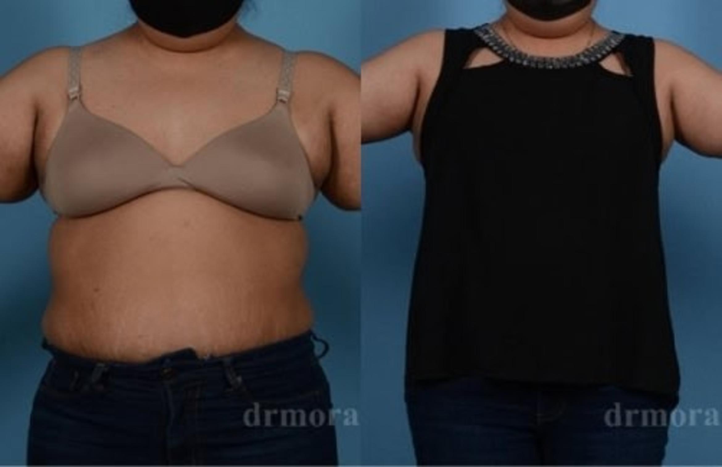 Before & After Arm Lift Case 298 View 1 View in Houston, TX