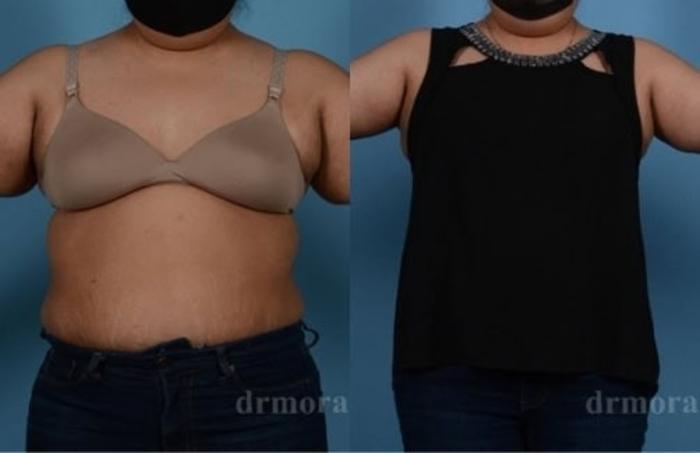 Before & After Arm Lift Case 298 View 1 View in Houston, TX