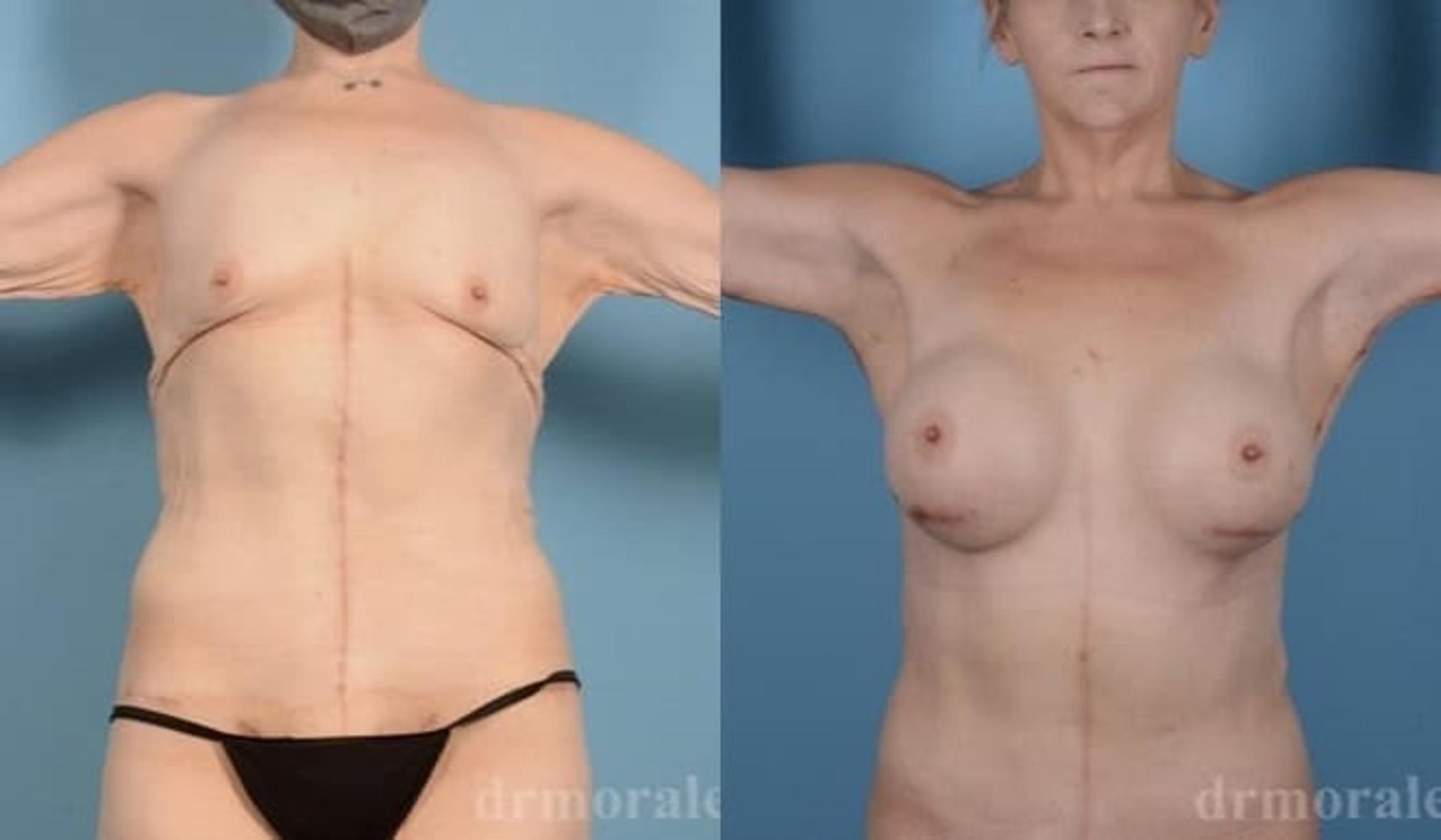 Before & After Arm Lift Case 299 View 1 View in Houston, TX