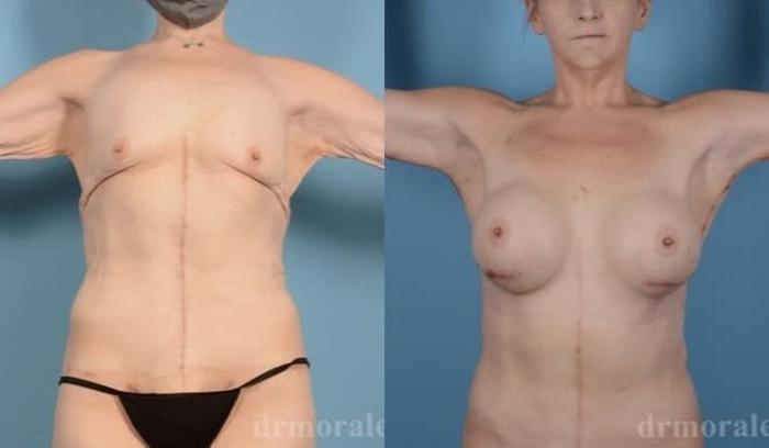 Before & After Arm Lift Case 299 View 1 View in Houston, TX