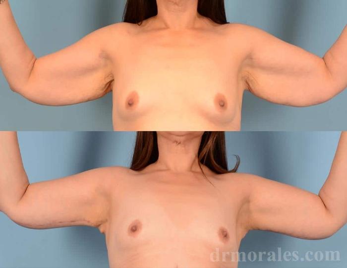 Before & After Arm Lift Case 41 View 1 View in Houston, TX