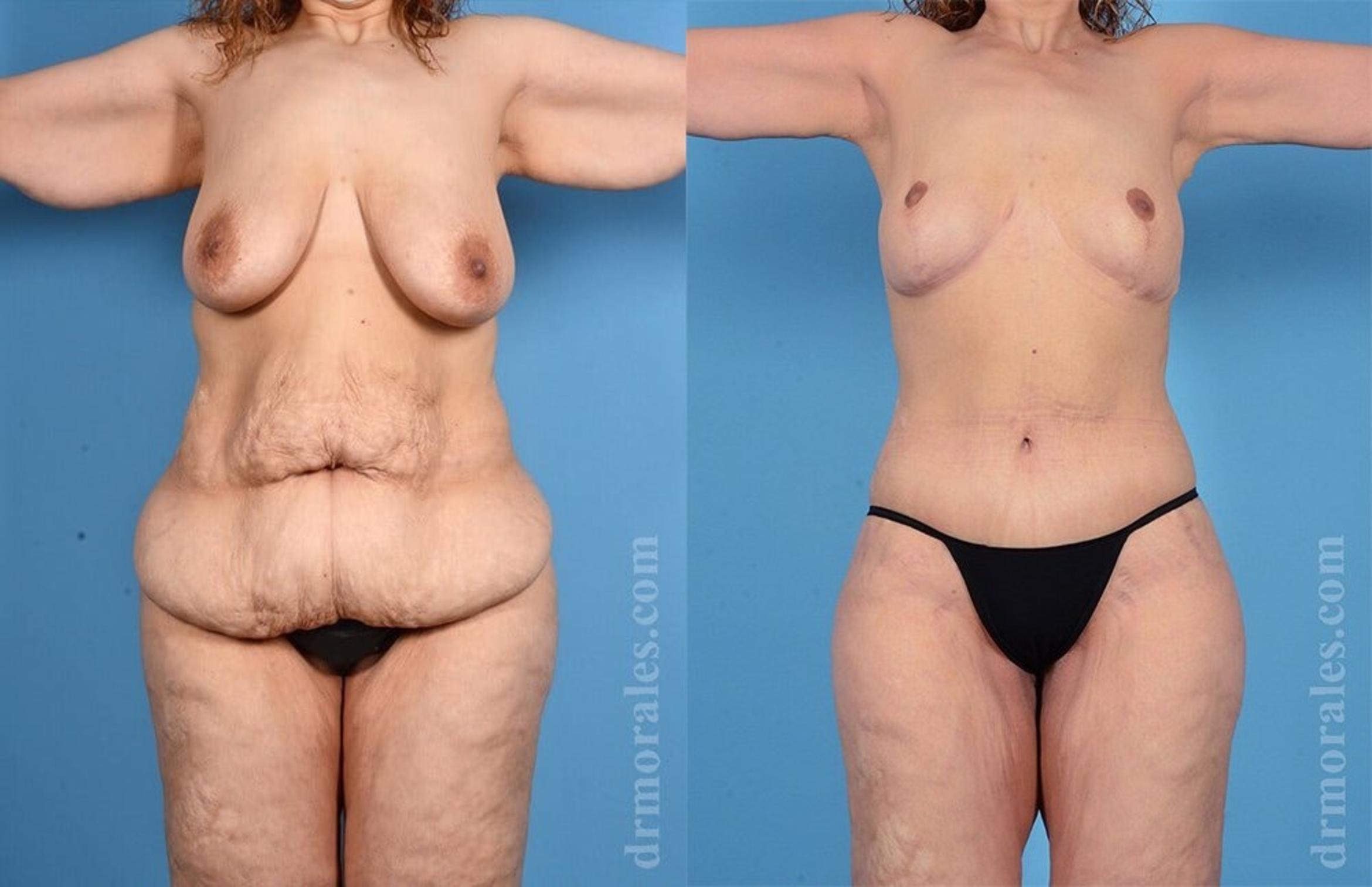 Before & After Liposuction Case 462 View 1 View in Houston, TX