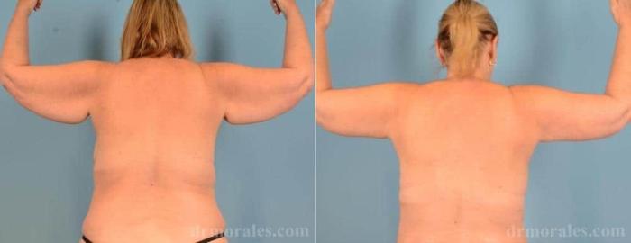 Before & After Arm Lift Case 51 View 1 View in Houston, TX