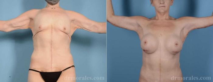 Before & After Arm Lift Case 95 View 1 View in Houston, TX