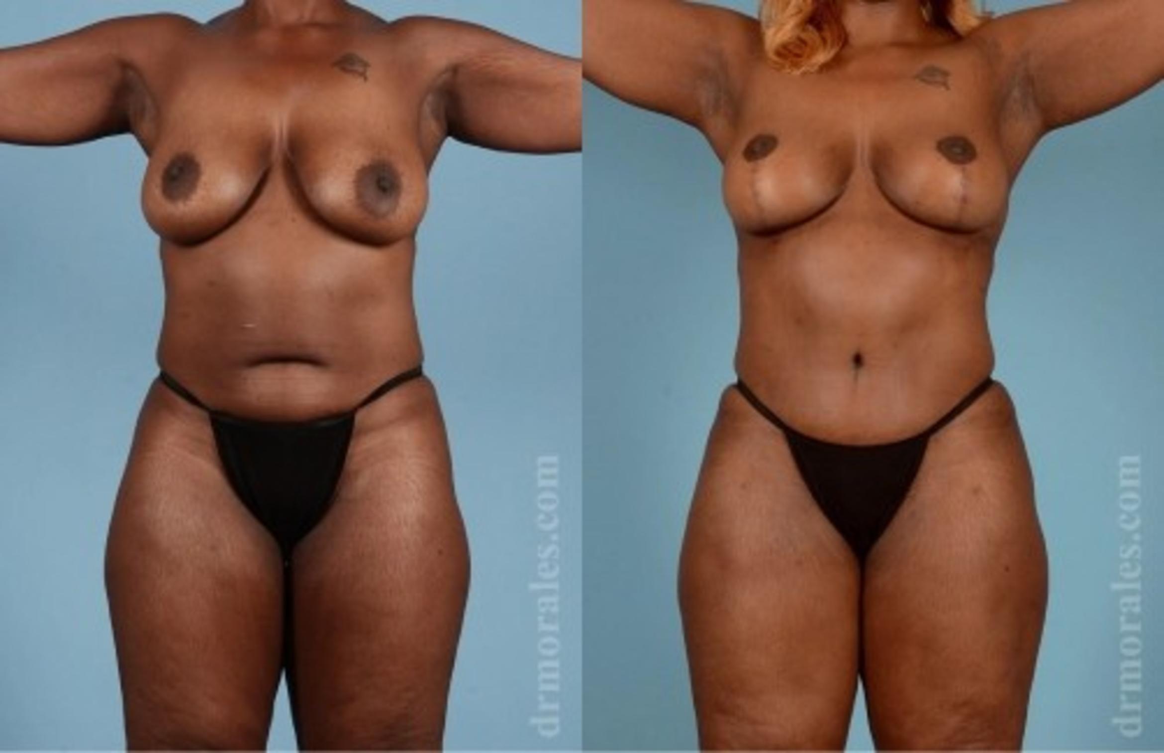 Before & After Breast Augmentation With Lift Case 719 View 1 View in Houston, TX