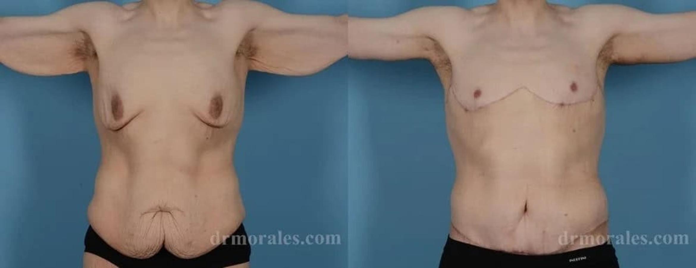 Before & After Body Lift Case 104 View 1 View in Houston, TX