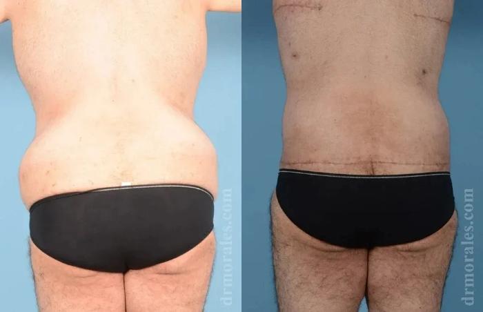 Before & After Body Lift Case 105 View 1 View in Houston, TX