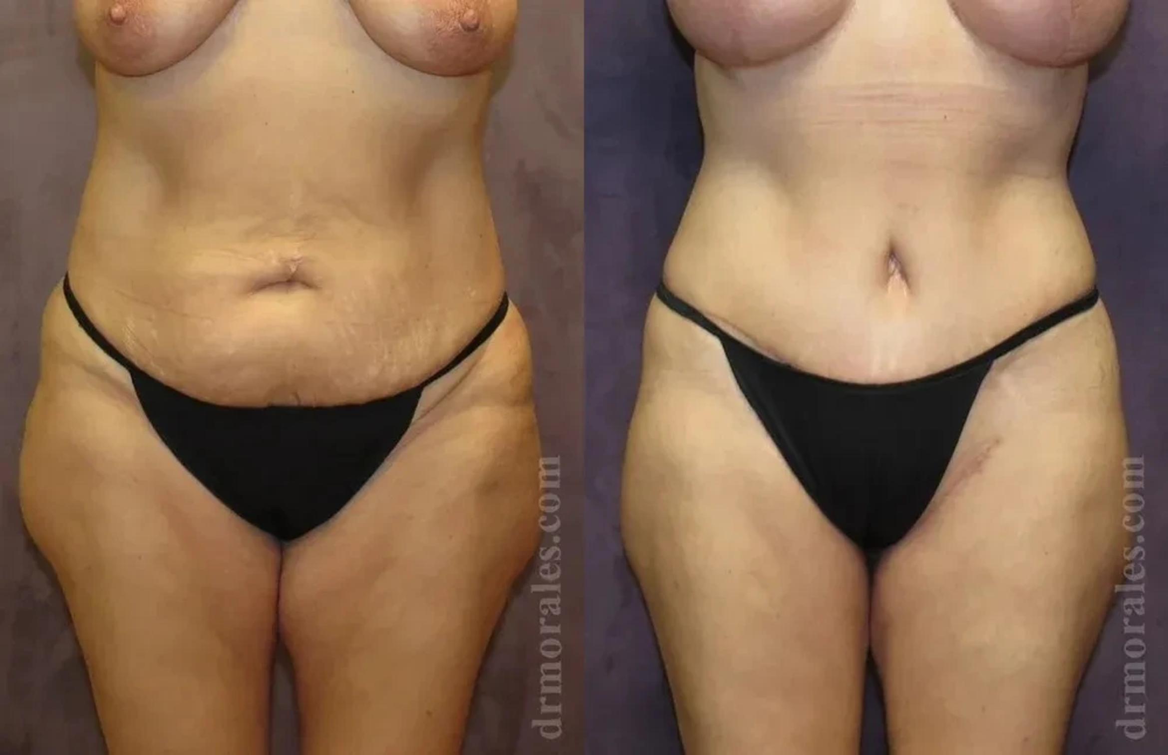 Before & After Body Lift Case 106 View 1 View in Houston, TX