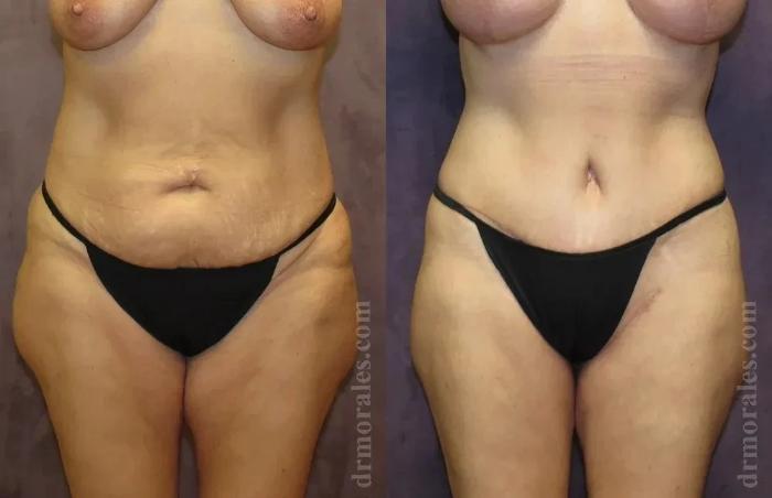Before & After Body Lift Case 106 View 1 View in Houston, TX