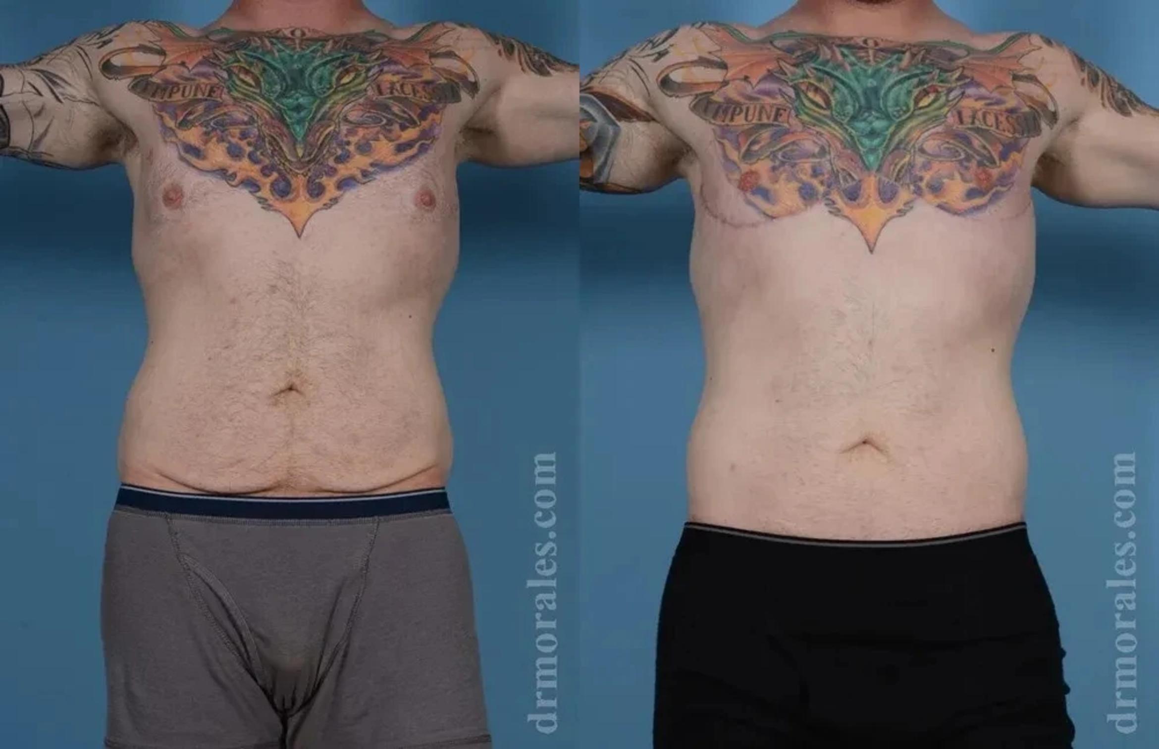 Before & After Body Lift Case 107 View 1 View in Houston, TX