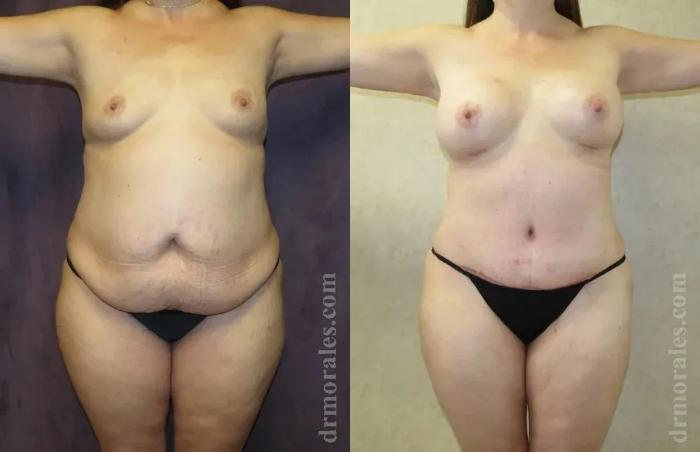 Before & After Body Lift Case 108 View 1 View in Houston, TX